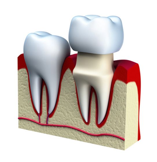 Digital illustration showing the components and location of a dental crown